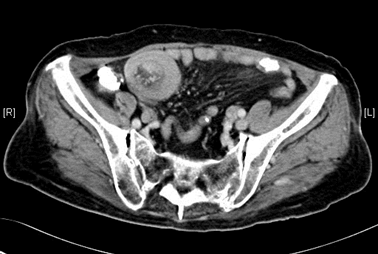 small bowel tumor